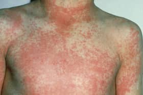 After 12 to 48 hours the characteristic fine red rash of scarlet fever develops