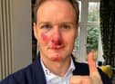 Dan Walker says he has no memory of the crash which left him bloody and bruised. Credit: Dan Walker