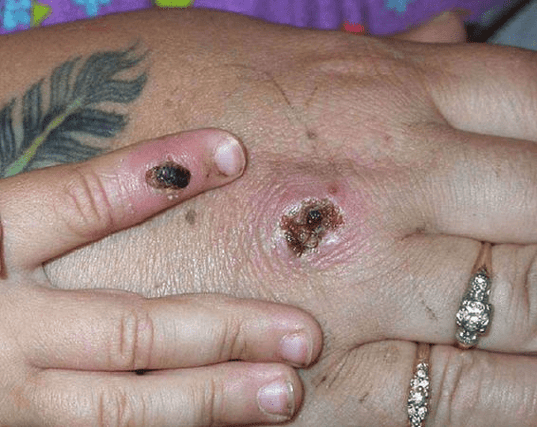 Monkeypox is a rare disease caused by infection with the monkeypox virus (Photo: CDC/Getty Images)