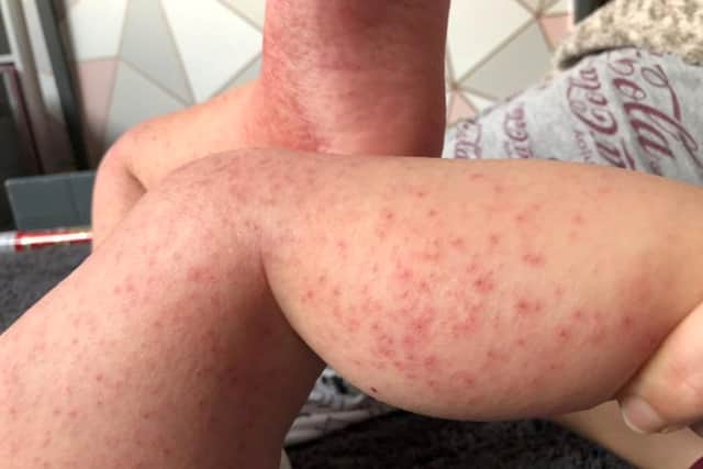 A measles rash on 11-month-old Levi Dale.