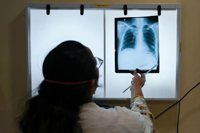 Tuberculosis (TB) cases in England have increased by 13%.