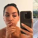 Northern Ireland woman woke up with a badly swollen eye on her wedding day after being bit by an insect.