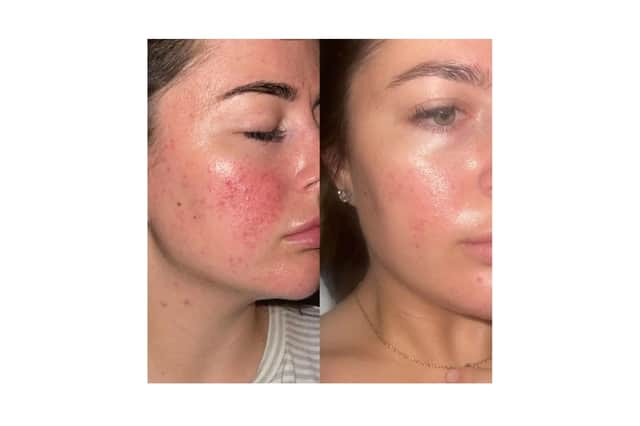 Jaime's results 47 Skin 