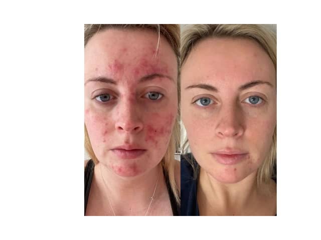Abigail's results 47 Skin 