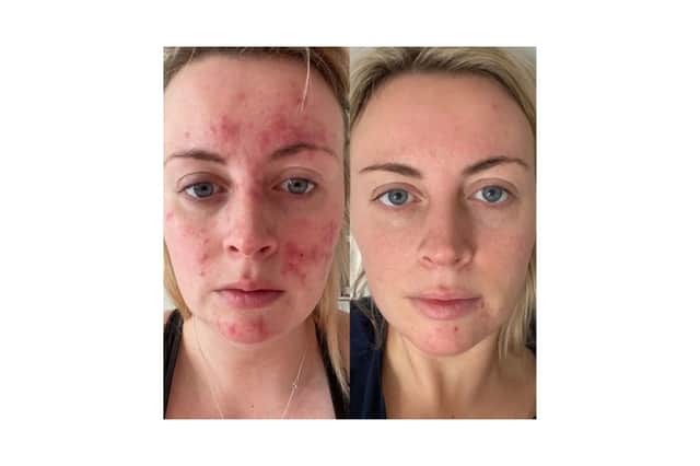 Abigail's results 47 Skin 
