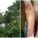 Giant hogweed can cause severe burns if the skin comes into contact with it.