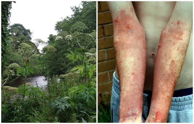 Giant hogweed can cause severe burns if the skin comes into contact with it.