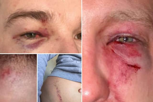 Some of the injuries to Emmett's eye (top left) and to Luke's face and body (top right and bottom two pictures)