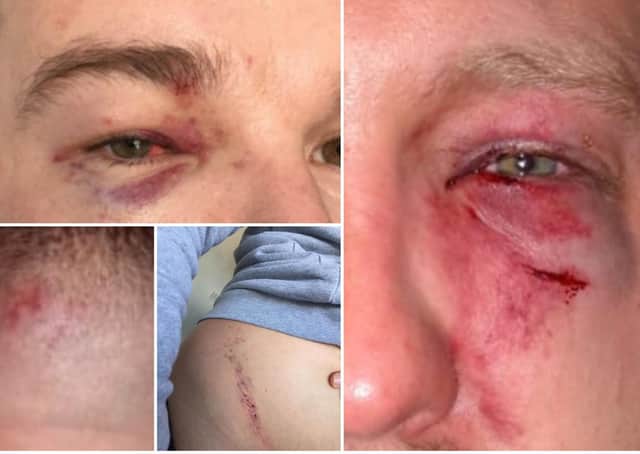 Some of the injuries to Emmett's eye (top left) and to Luke's face and body (top right and bottom two pictures)