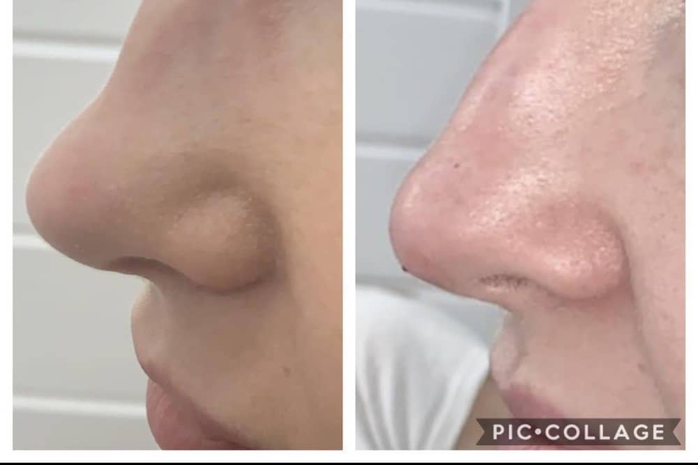 An example of Liquid Rhinoplasty.