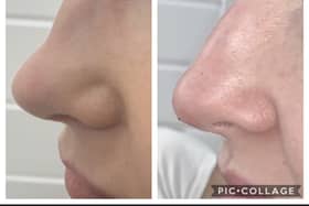 An example of Liquid Rhinoplasty.