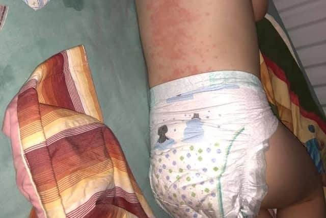 The rash all over Hannah's back. It was a student doctor who first raised the possibility that the toddler had Kawasaki Disease, a rare condition that affects children under five.