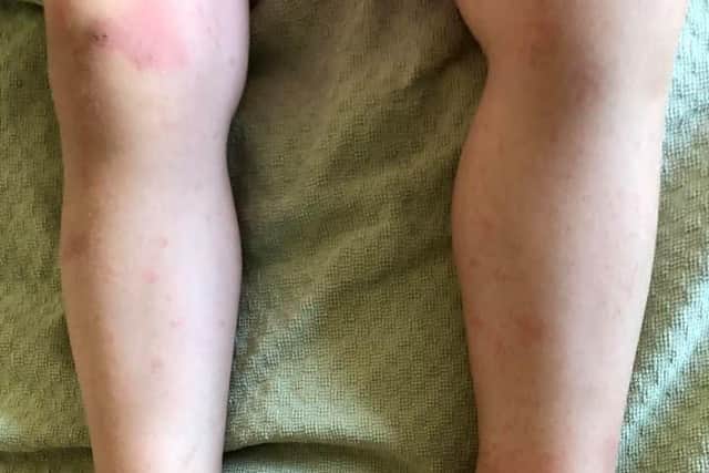Kawasaki Disease  causes swelling of the blood vessels throughout the body. It causes a high fever and rash. It can also affect the blood vessels supplying the heart muscle. Hannah had swelling, the tell tale rash and a consistent temperature.