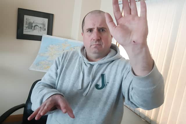 Seamus Baldrick displaying his injuries in the ‘Journal’ office.