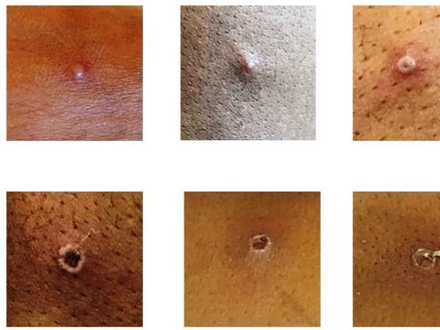 What monkeypox can look like on the body.