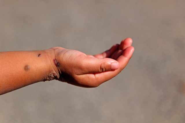 A child's hand with Monkeypox.