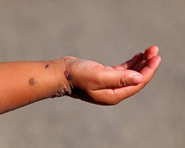 A child's hand with Monkeypox.