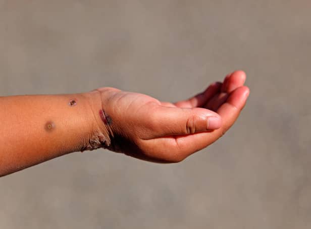 A child's hand with Monkeypox.