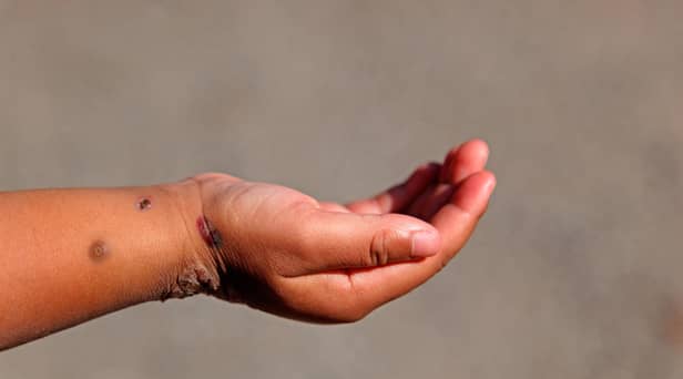 A child's hand with Monkeypox.