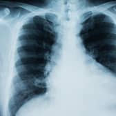 Mesothelioma is a cancer mainly affecting the lungs.