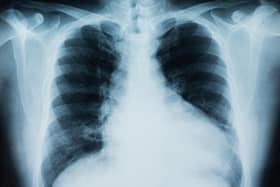 Mesothelioma is a cancer mainly affecting the lungs.