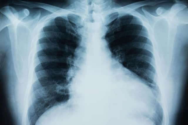 Mesothelioma is a cancer mainly affecting the lungs.