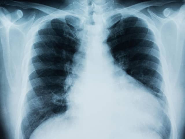 Mesothelioma is a cancer mainly affecting the lungs.