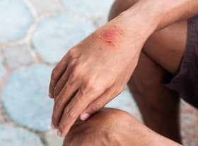 People who are bitten by mammals are susceptible to rabies. Fresh wounds are susceptible to infection. The Public Health Agency (PHA) is advising people to get the rabies vaccine if they are travelling abroad this summer.