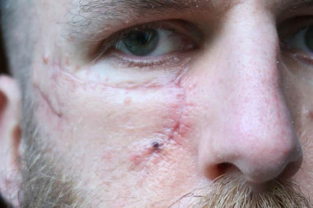 James has been left with a scar as a result of the skin cancer he had removed.
