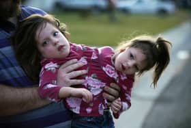 Three year old co-joined twins Callie and Carter