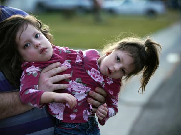 Three year old co-joined twins Callie and Carter
