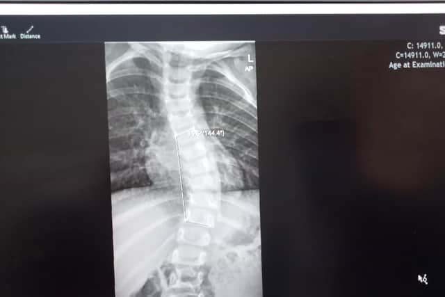 Two year old Patricks x-ray scans show the curvature of his spine. Patrick has to travel to America to get treatment for his scoliosis, which will mean he won't have to get surgery on his spine when he is older.
