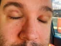 Injuries sustained by Councillor Emmet Doyle in an assault last week.
