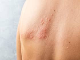 Shingles