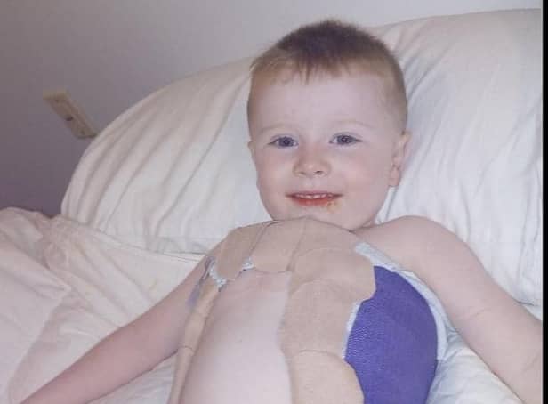 Little Patrick Burke after getting his first cast in America to treat his scoliosis.