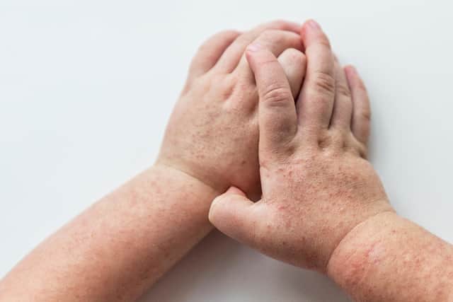 Symptoms of a Strep A infection include a red 'sandpaper' rash.