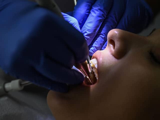 Derry City and Strabane had the highest rate of children treated for fillings, crowns or extractions in the north in 2022/23 with 223 per 1,000, new dental statistics show. (Photo by Ozan KOSE / AFP) (Photo by OZAN KOSE/AFP via Getty Images)