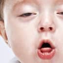 A boy suffering from whooping cough.
