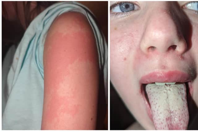 Young Katie was displaying scarlet fever symptoms including a coated tongue and rash.