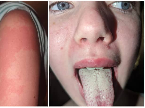 Young Katie was displaying scarlet fever symptoms including a coated tongue and rash.