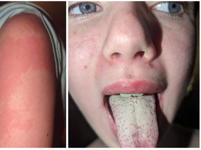Young Katie was displaying scarlet fever symptoms including a coated tongue and rash.
