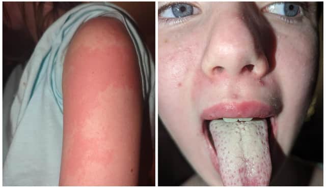 Young Katie was displaying scarlet fever symptoms including a coated tongue and rash.