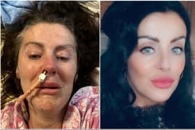 Bernie in hospital after a brain aneurysm ruptured while driving her car, and as she is today.