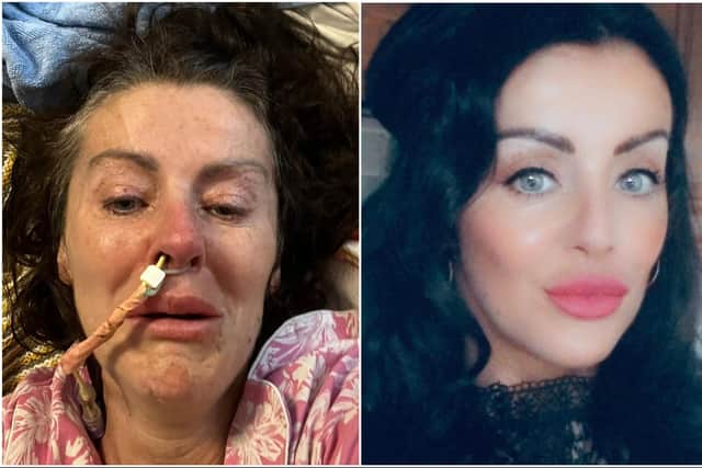 Bernie in hospital after a brain aneurysm ruptured while driving her car, and as she is today.