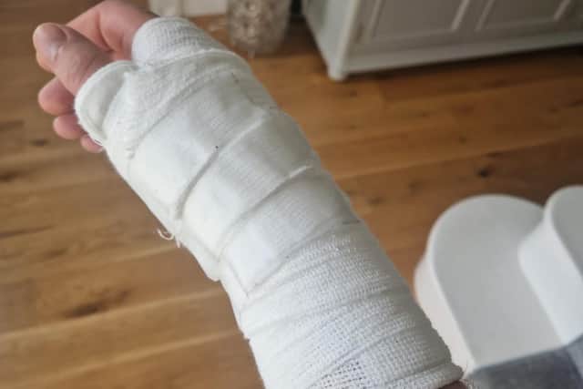 The bandaged wrist and hand of a police officer injured during disorder in Creggan on Thursday.