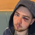 Connor Muirhead (21) sustained injuries to his face after he was assaulted.