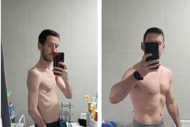 Cathal pictured on the left during his hospital stay and, on the right, during his recovery.