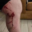 A cyclist has suffered gashes to his leg after coming his bicycle while trying to avoid trees felled by Storm Éowyn out the ‘Line’ in Derry.