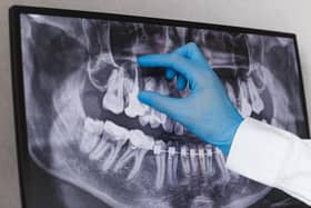 Derry & Strabane has the highest rate of dental extractions, fillings and crowns despite having among the lowest levels of dental coverage in the North.