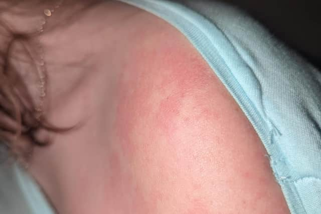 Rash is a symptom of scarlet fever.